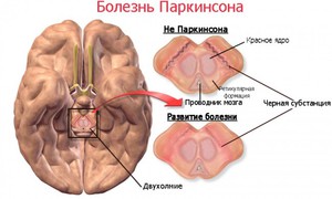 Что такое болезнь Паркинсона