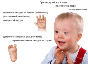 Олигофрения у детей - первые признаки