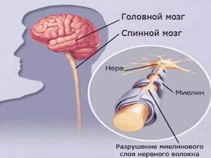 Причины развития оптиконевромиелита