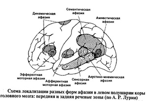 Разновидности афазии