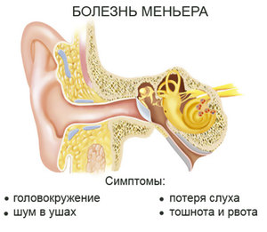 Лечение симптомов  Маньера