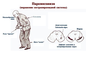 Как помочь пациентам с синдромом Паркинсона