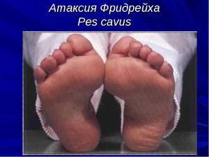 Заболевание атаксия Фредрейха