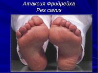 Заболевание атаксия Фредрейха