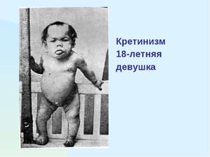 Больная кретинизмом в 18 лет